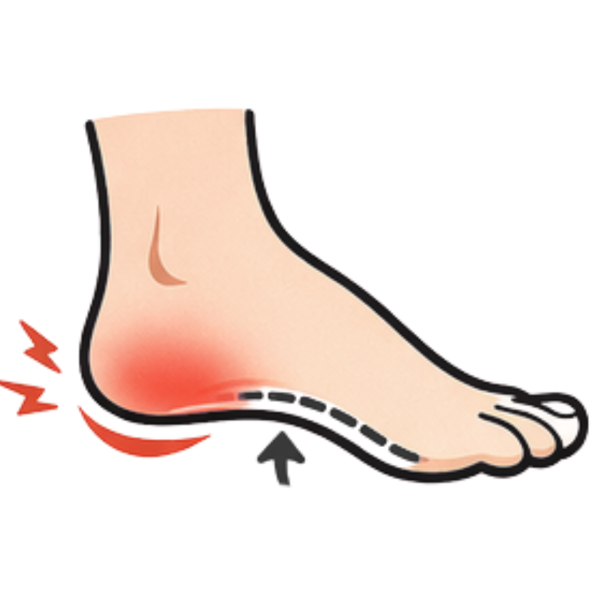 plantar fasciitis arch and heel pain