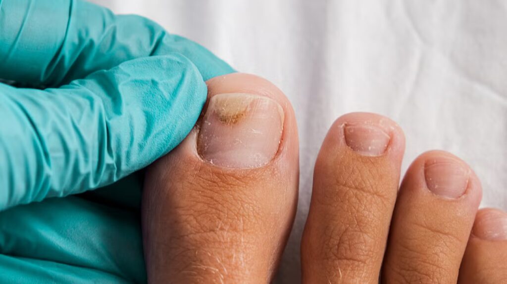toenail lifting